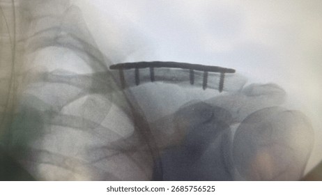 Internal fixation with a locking plate adressing a midshaft clavicle fracture 