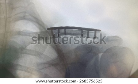 Internal fixation with a locking plate adressing a midshaft clavicle fracture 