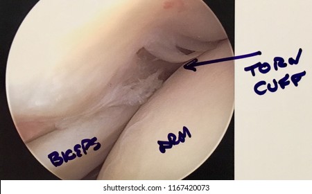 Internal Images Of Arthroscopy Surgery On Mans Right Shoulder Torn Rotator Cuff