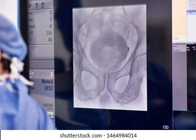 Interventional Radiology. Prostatic Artery Embolization (PAE)