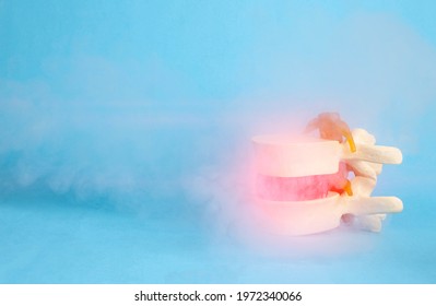 Intervertebral Disc With A Herniated Spine On A Blue Background, Smoke From Low Temperatures. The Concept Of Cold Spine Treatment, Cryotherapy And Ozone Therapy. Removal Of Edema And Inflammation. 