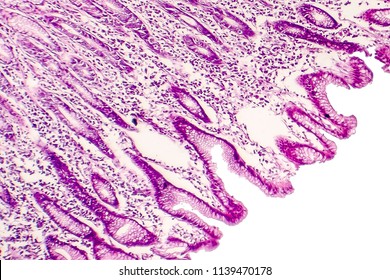 Intestinal Metaplasia Stomach Light Micrograph Photo Stock Photo (Edit ...