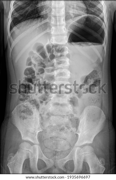 intestinal obstruction in a child x ray, Film\
X-ray body of child.