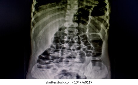 Intestinal Obstruction Radiography Medical Education Shot Stock Photo Shutterstock