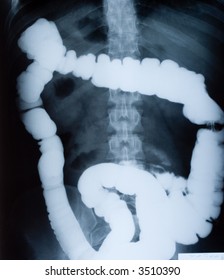 Intestine And Spine X-ray