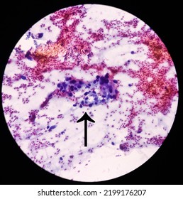 Intra Abdominal Mass(Cytology): Spindle Cell Sarcoma, Positive Malignant Cells. Pleomorphic Undifferentiated Sarcoma, Malignant Fibrous Histiocytoma.