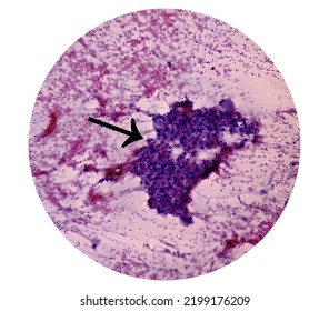 Intra Abdominal Mass(Cytology): Spindle Cell Sarcoma, Positive Malignant Cells. Pleomorphic Undifferentiated Sarcoma, Malignant Fibrous Histiocytoma.