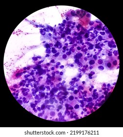 Intra Abdominal Mass(Cytology): Spindle Cell Sarcoma, Positive Malignant Cells. Pleomorphic Undifferentiated Sarcoma, Malignant Fibrous Histiocytoma.