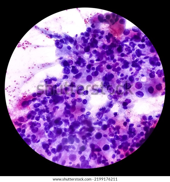 Intra abdominal mass(Cytology): Spindle\
cell sarcoma, positive malignant cells. Pleomorphic\
undifferentiated sarcoma, malignant fibrous\
histiocytoma.