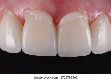 Intra oral try in step or mock up before permanent bonding and installation of dental ceramic veneers.