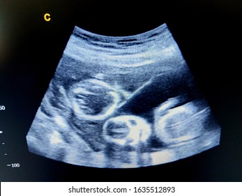 intra twins septum by ultrasound scan  - Shutterstock ID 1635512893
