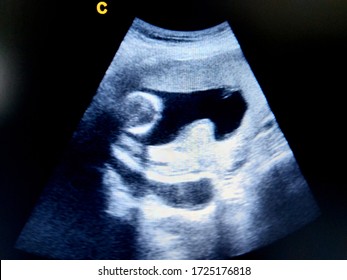 Intra Uterine Contraction / Tonus  In Pregnancy By Ultrasound