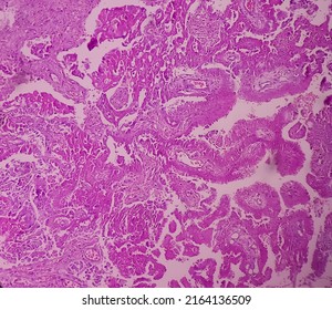 Intra-cranial Space Occupying Lesion(biopsy): Brain Cancer, Metastatic Papillary Adenocarcinoma, Papillary Meningioma, Show Brain Tissue, Necrosis Present. Malignant Tumor.