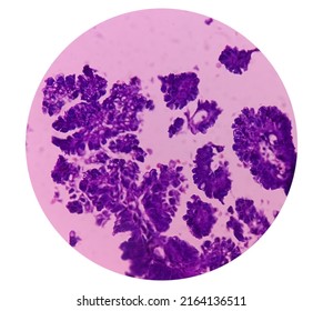 Intra-cranial Space Occupying Lesion(biopsy): Brain Cancer, Metastatic Papillary Adenocarcinoma, Papillary Meningioma, Show Brain Tissue, Necrosis Present. Malignant Tumor.