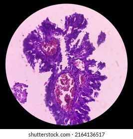 Intra-cranial Space Occupying Lesion(biopsy): Brain Cancer, Metastatic Papillary Adenocarcinoma, Papillary Meningioma, Show Brain Tissue, Necrosis Present. Malignant Tumor.