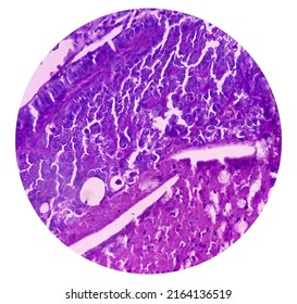 Intra-cranial Space Occupying Lesion(biopsy): Brain Cancer, Metastatic Papillary Adenocarcinoma, Papillary Meningioma, Show Brain Tissue, Necrosis Present. Malignant Tumor.