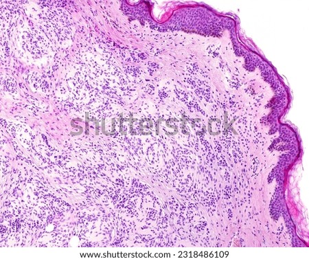 Intradermal nevus is a proliferation of melanocytes. They show strands or nests of melanocytes, small cells with scant cytoplasm and regular nuclei separated by a stroma rich in collagen fibers.
