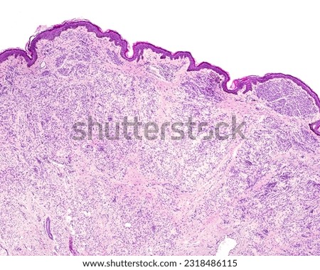 Intradermal nevus is a proliferation of melanocytes. They show strands or nests of melanocytes, small cells with scant cytoplasm and regular nuclei separated by a stroma rich in collagen fibers.
