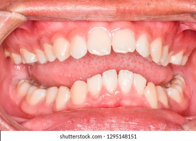 Intra-oral deep bite teeth and gum in the smile mouth oral care. No dental cavity  or caries. Bacteria, dental plaque is the cause of gingivitis and tooth decayed which need to meet dentist at clinic
