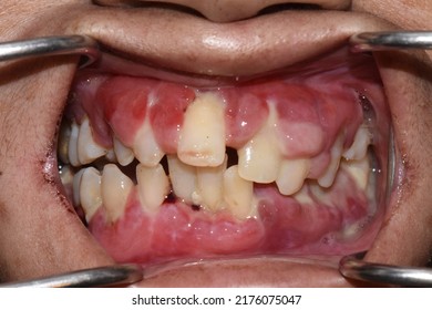 Intraoral Picture Showing Generalised Swelling Of Gums With Poor Oral Hygiene