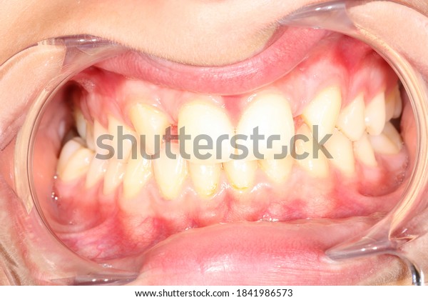 Intra-oral picture of teeth and\
gum in the smile mouth oral care. Bacteria, dental plaque is the\
cause of gingivitis and tooth decayed. Mouth opener used by\
dentistry