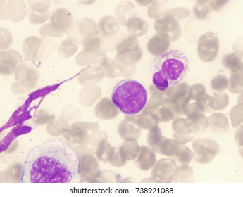 Intravascular Large B Cell Lymphoma