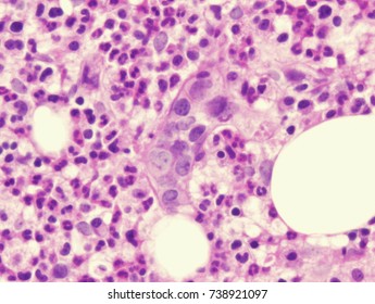 Intravascular Large B Cell Lymphoma