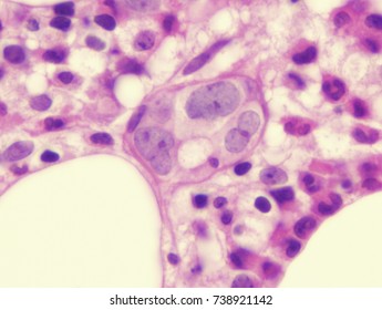 Intravascular Large B Cell Lymphoma