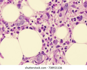 Intravascular Large B Cell Lymphoma/leukemia