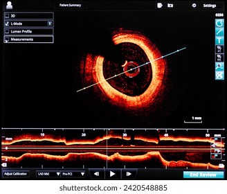 intravascular optical coherence tomography oct image angiography catheter lab atherosclerosis. measurement of coronary artery in cross-sectional and longitudinal view. during cardiac catheterization.