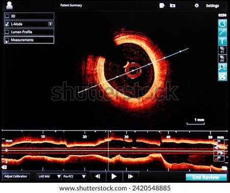 intravascular optical coherence tomography oct image angiography catheter lab atherosclerosis. measurement of coronary artery in cross-sectional and longitudinal view. during cardiac catheterization.