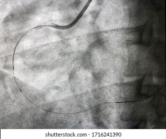 Intravascular Ultrasond (IVUS) Catheter Advance To Right Coronary Artery (RCA) During Percutaneous Coronary Intervention (PCI).