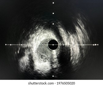 Intravascular Ultrasound Imaging Ivus Shown Guide: стоковая фотография ...