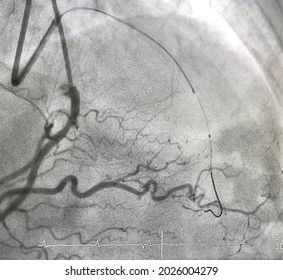 Intravascular Ultrasound (IVUS) Catheter Advance To Chronic Total Occlusion (CTO) Of Left Anterior Descending Artery (LAD). 