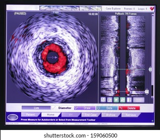 Intravascular Ultrasound Study. Latest Technology In Medicine.