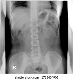 Intravenous pyelogram. Supine position. Intestinal gas partially overlying both renal shadows.  Kidney shadows appear normal in size, shape, position.