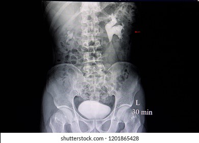Intravenous pyelogram xray film of a patient with hydronephrosis and multiple kidney stones. Renal calculi. Diagnosis procedure for kidney stone.