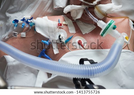 Intubated patient in crirtical stance, central venous catheter installed in jugulares vena
