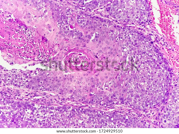 Invasive Squamous Cell Carcinoma Keratin Pearl Stock Photo 1724929510 ...