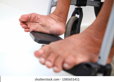 Irregular And Small Legs Are Caused By Polio On The Stairs Of A Wheelchair.