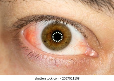 Irritated Eye, Irritated Eye From Scleritis, Redness Of The Sclera, Inflammation In The White Part Of The Eye.