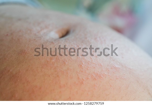 Irritated Skin During Pregnancy