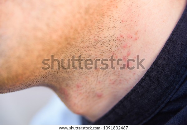 irritation-after-shaving-sores-shaving-on-stock-photo-1091832467