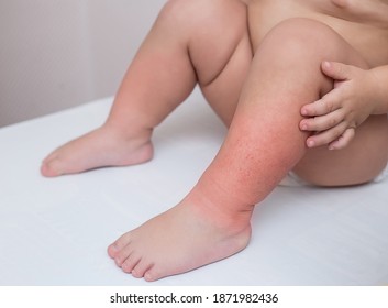 Irritation On The Feet Of A Child Due To Dry Skin In Winter.