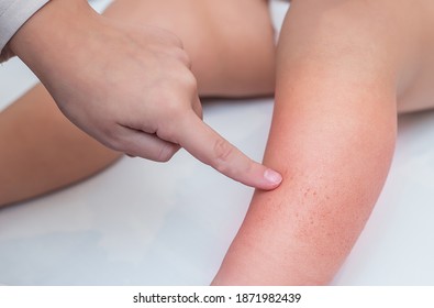 Irritation On The Feet Of A Child Due To Dry Skin In Winter.