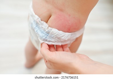 irritation on the skin of the baby from the diaper close-up.