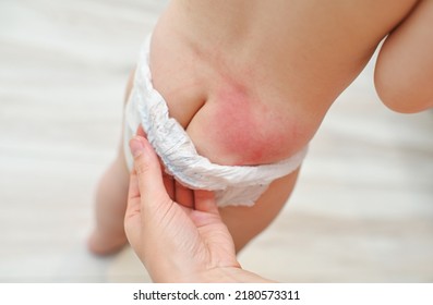 irritation on the skin of the baby from the diaper close-up.