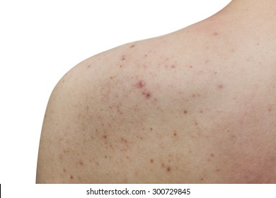 Isolated Acne On A Man Back