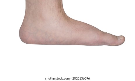 Isolated Close-up Of A Child's Bare Foot With A Strong Flat Foot, Also Called Pes Planus Or Fallen Arches.