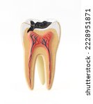 Isolated photo of internal tooth structure model with caries destruction on white background